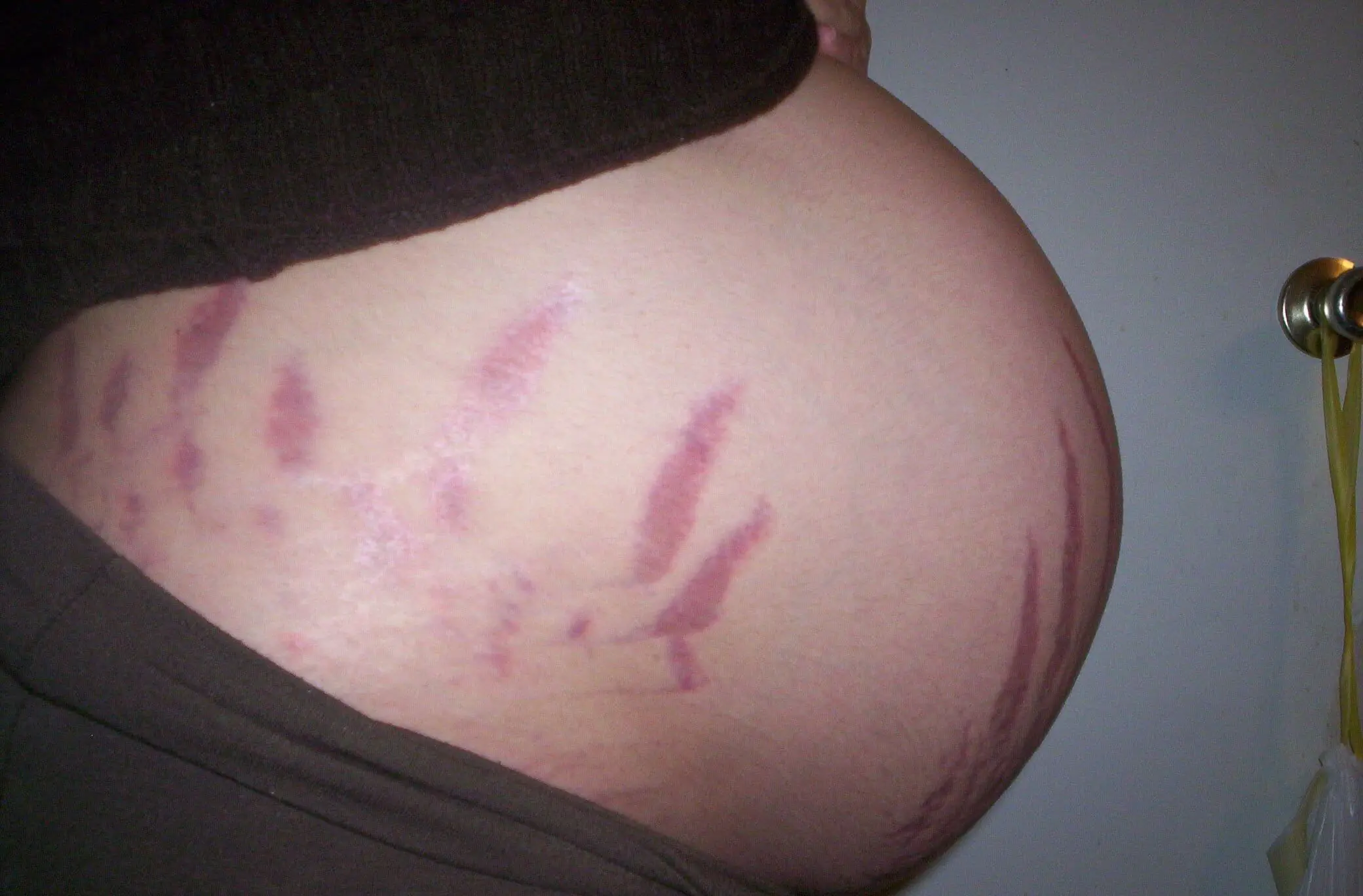Растяжки во время беременности: причины появления и как предотвратить 
